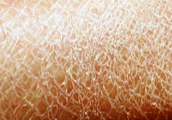 Cara Mengatasi Kulit Kering dengan Alami dan Mudah Dilakukan