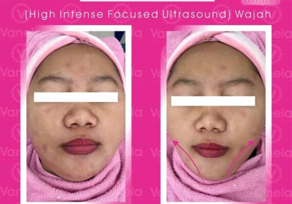 perawatan kecantikan di klinik vanela beauty care_39e20ec1d.jpg