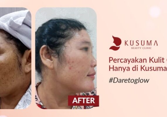harga perawatan di kusuma beauty lab_673cbd45b.jpg