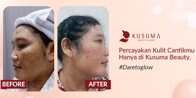 Harga Perawatan Di Kusuma Beauty Lab